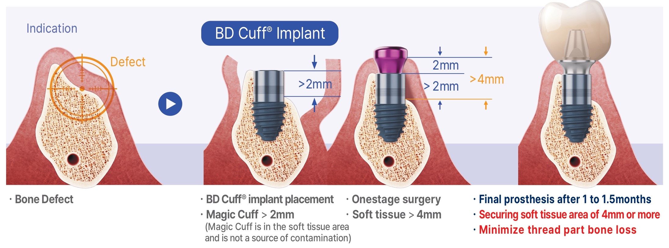 Conceito BD Cuff em defeito ósseo