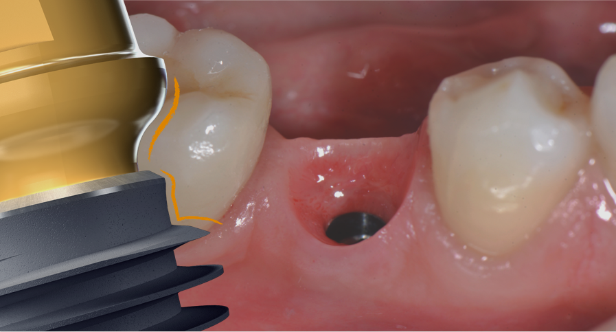 Implant Image