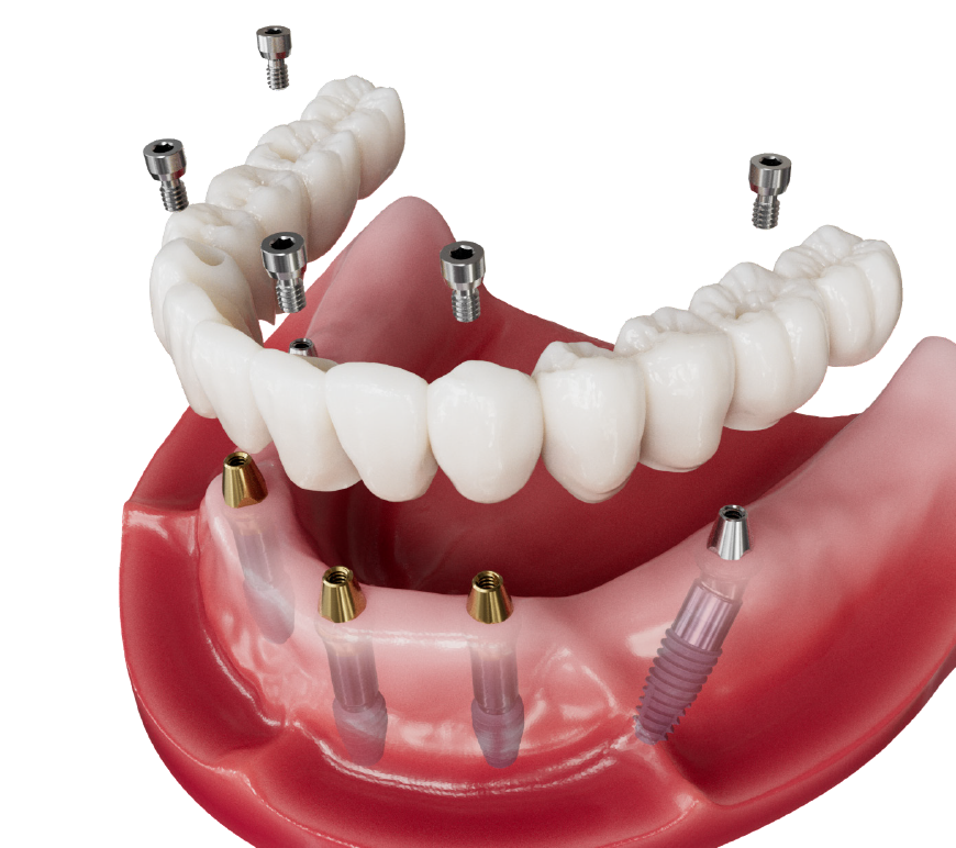AXA Abutment
