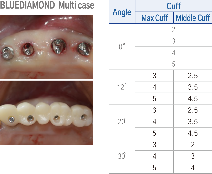 AXA Abutment