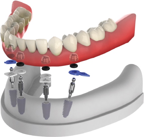 Overdenture