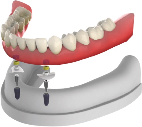 Overdenture