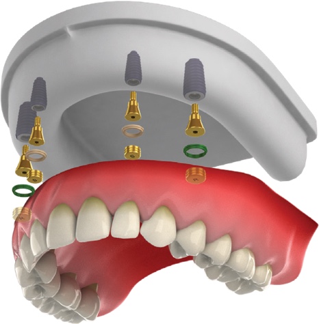Overdenture