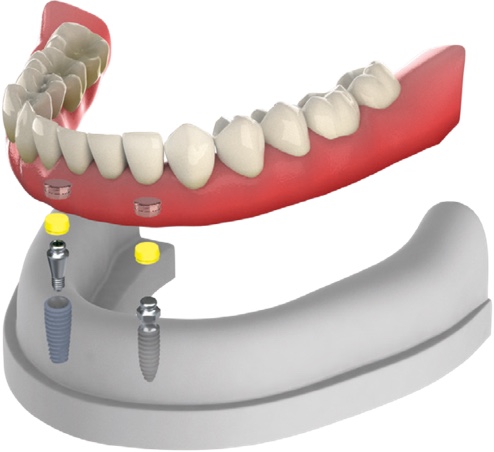 Overdenture
