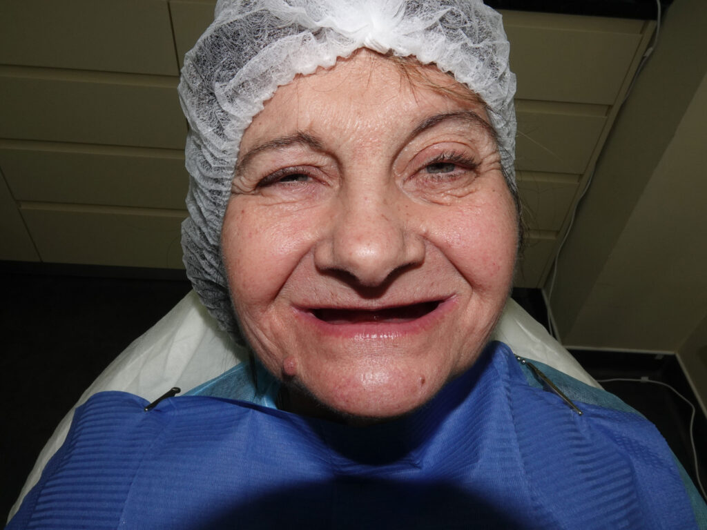 Full-Arch Implant Rehabilitation of the Atrophic Maxilla and Mandible Using MegaGen® Implants and Osseodensification — Abstract