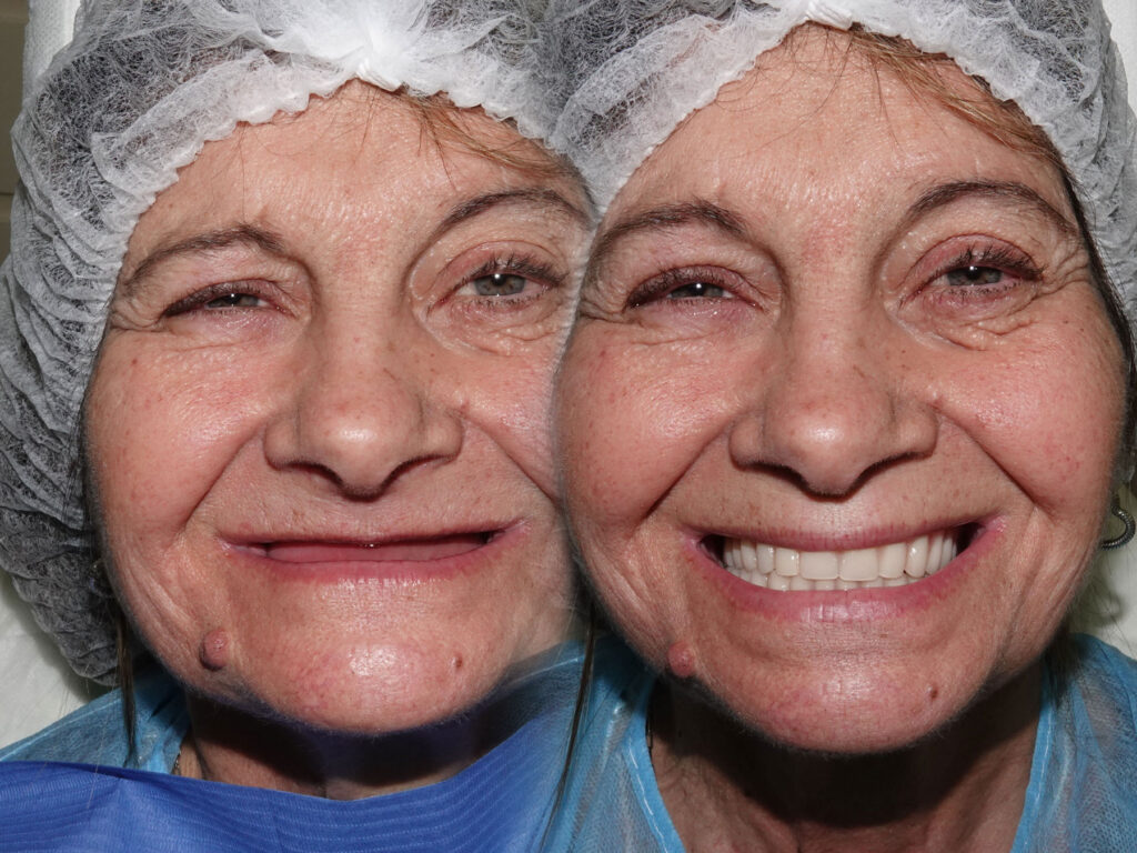 Casos Clínicos — Full-Arch Implant Rehabilitation of the Atrophic Maxilla and Mandible Using MegaGen® Implants and Osseodensification