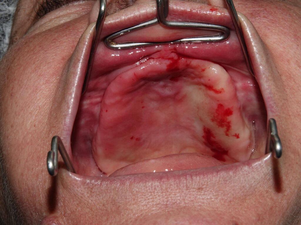 Full-Arch Implant Rehabilitation of the Atrophic Maxilla and Mandible Using MegaGen® Implants and Osseodensification — Abstract