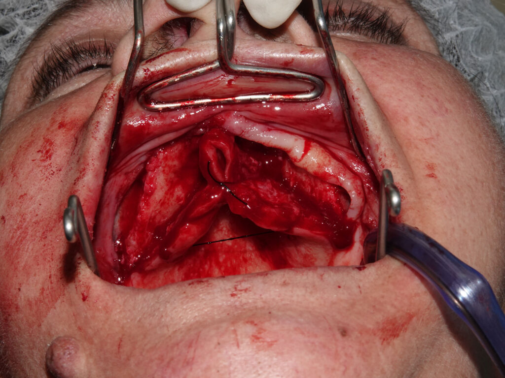 Full-Arch Implant Rehabilitation of the Atrophic Maxilla and Mandible Using MegaGen® Implants and Osseodensification — Abstract
