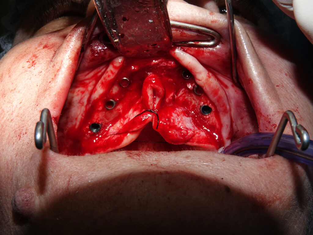 Full-Arch Implant Rehabilitation of the Atrophic Maxilla and Mandible Using MegaGen® Implants and Osseodensification — Abstract