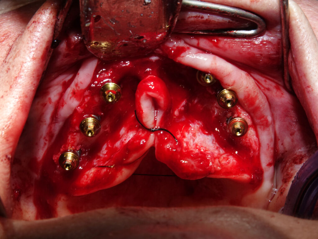 Full-Arch Implant Rehabilitation of the Atrophic Maxilla and Mandible Using MegaGen® Implants and Osseodensification — Abstract