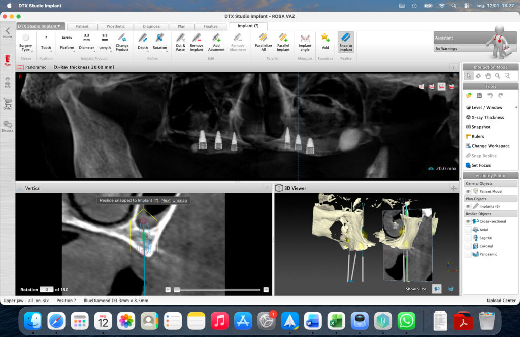 Full-Arch Implant Rehabilitation of the Atrophic Maxilla and Mandible Using MegaGen® Implants and Osseodensification — Abstract