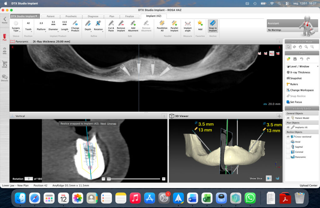 Full-Arch Implant Rehabilitation of the Atrophic Maxilla and Mandible Using MegaGen® Implants and Osseodensification — Abstract