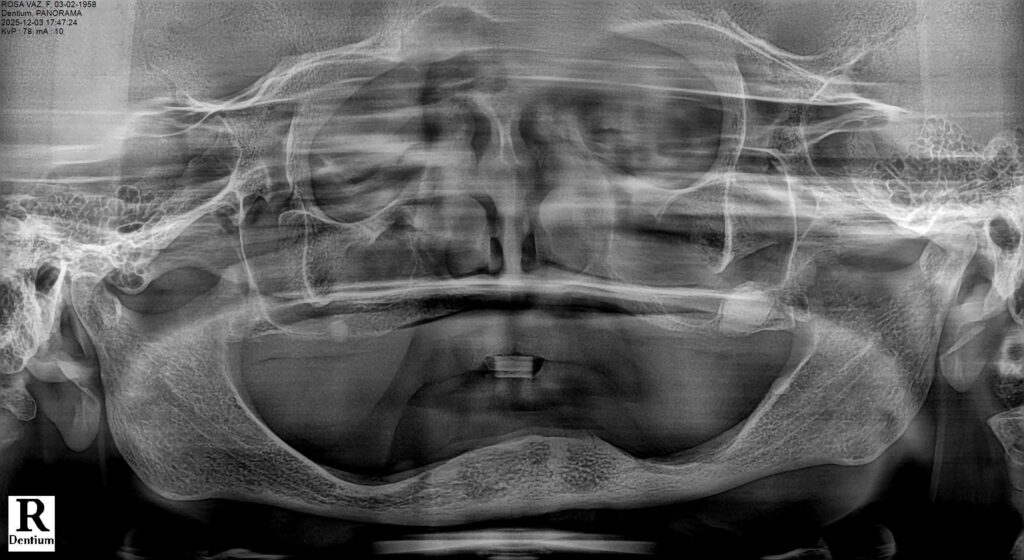 Full-Arch Implant Rehabilitation of the Atrophic Maxilla and Mandible Using MegaGen® Implants and Osseodensification — Abstract