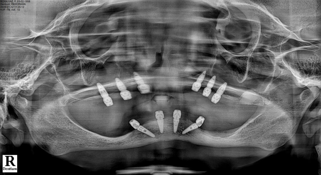 Full-Arch Implant Rehabilitation of the Atrophic Maxilla and Mandible Using MegaGen® Implants and Osseodensification — Abstract