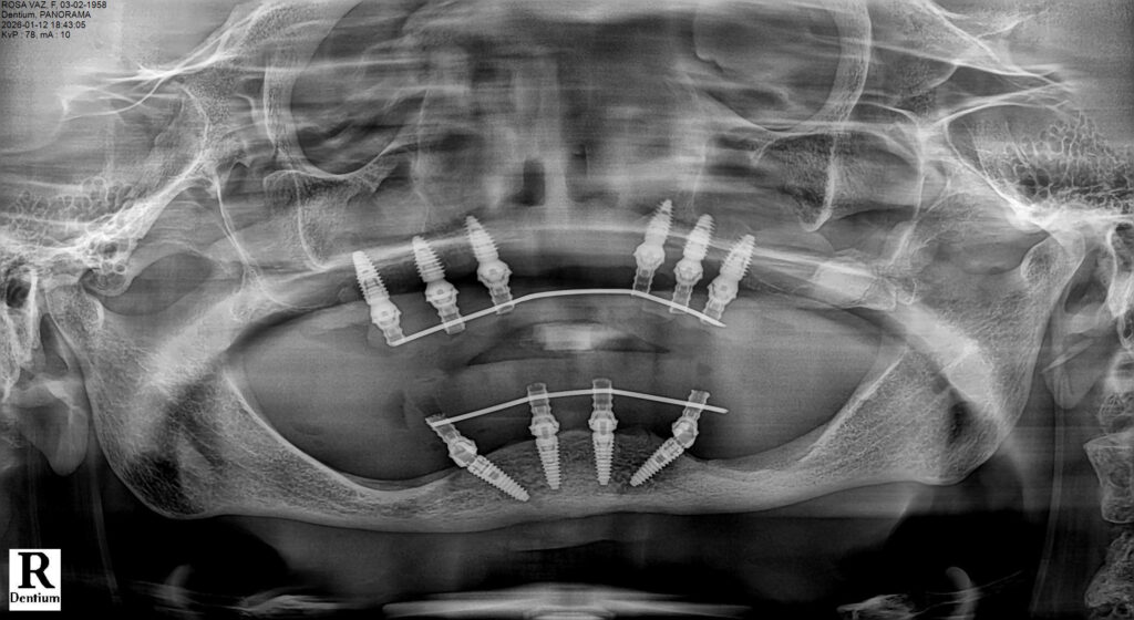 Full-Arch Implant Rehabilitation of the Atrophic Maxilla and Mandible Using MegaGen® Implants and Osseodensification — Abstract