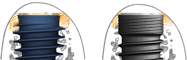 sistema de implantes