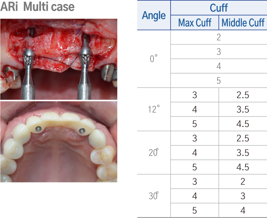 AXA Abutment