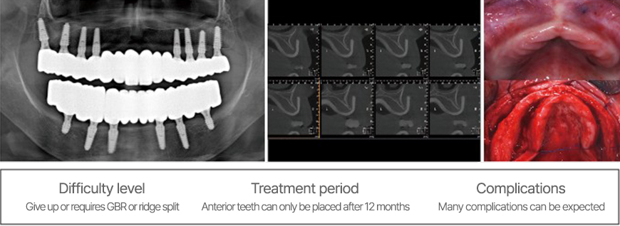 ari raio x implantes