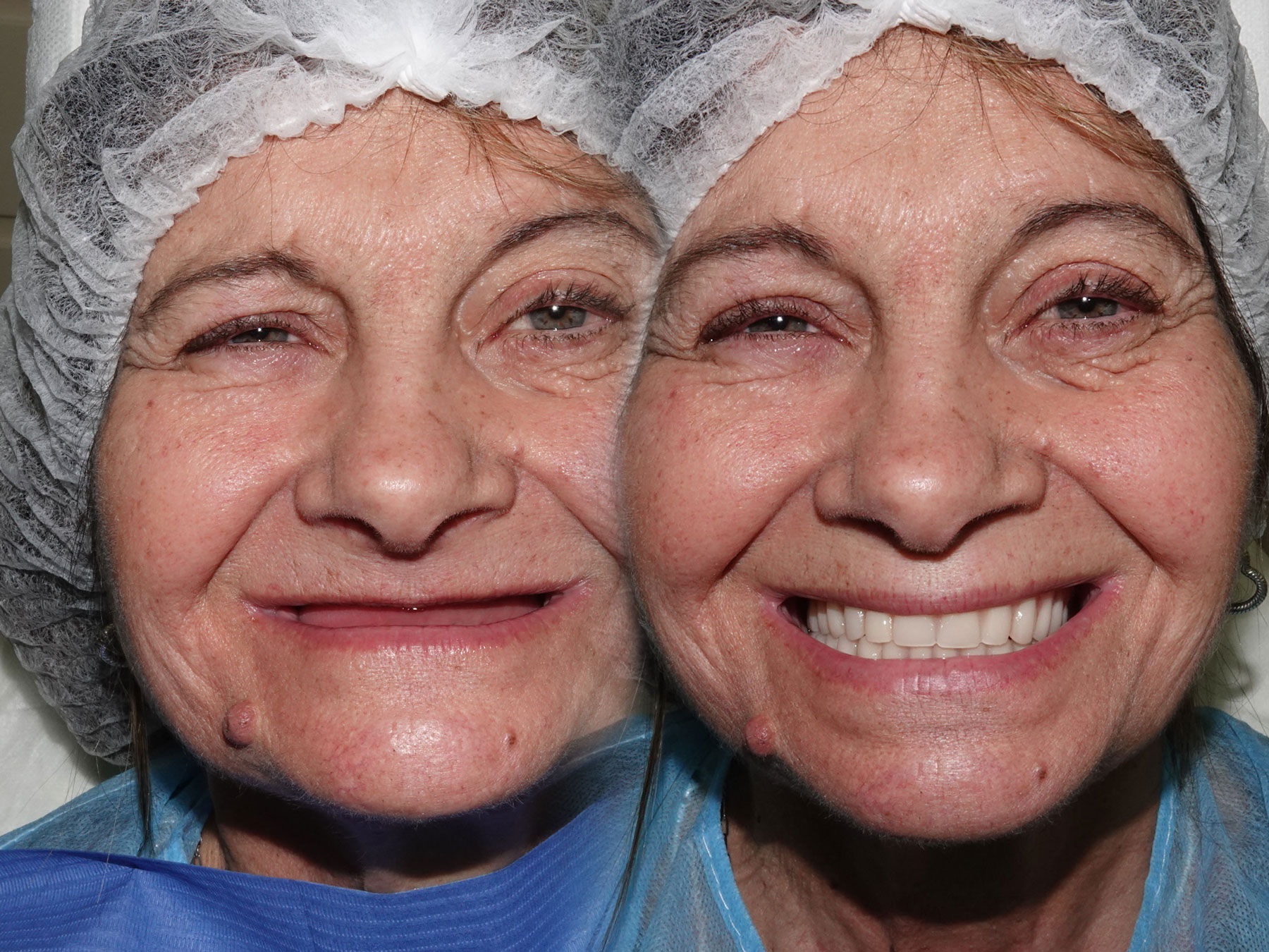 Full-Arch Implant Rehabilitation of the Atrophic Maxilla and Mandible Using MegaGen® Implants and Osseodensification